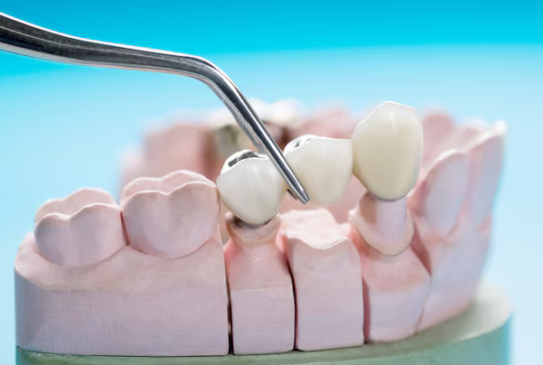 Custom-Made Dental Crowns: The Perfect Solution for Damaged and Discolored Teeth