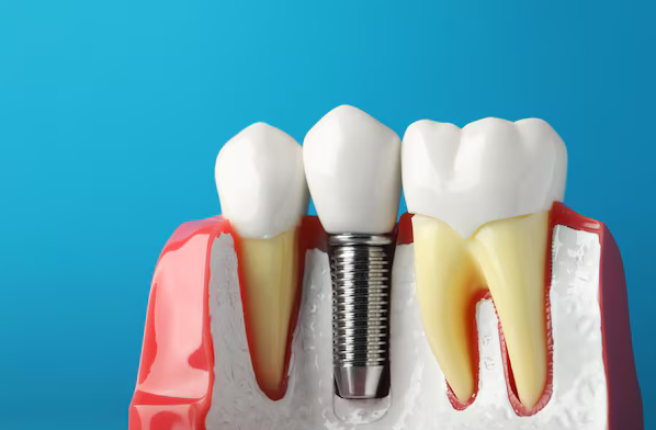 Dental Implants: Long-Lasting Tooth Replacement for Natural Smiles