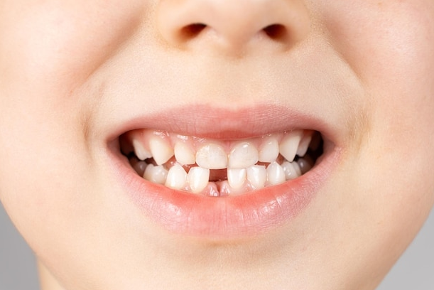 Understanding Tooth Agenesis: Causes and Solutions Exploring Treatment Options for Congenitally Missing Teeth