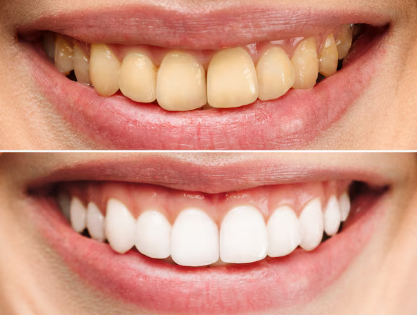 Teeth Whitening: Brighten Your Smile Safely and Effectively