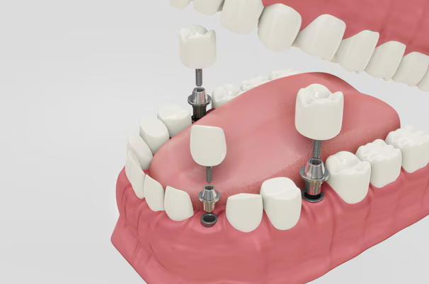 Full Arch Implants Restore Complete Smile with Stable, Natural Teeth Replacement