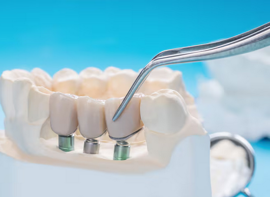 Closing the Gap for Good: A Practical Guide to Dental Bridges