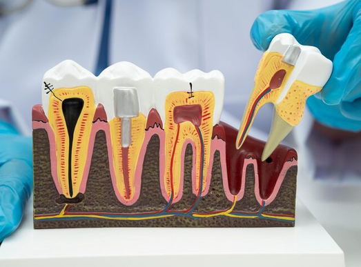 The Step-by-Step Guide to Root Canals: What to Expect from this Restorative Dental Procedure