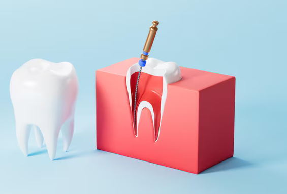 Saving the Tooth, Easing the Pain: What to Know About Root Canal Treatment