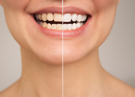 The Science Behind Teeth Whitening: How Bleaching Agents Work Removing Stains with Peroxide
