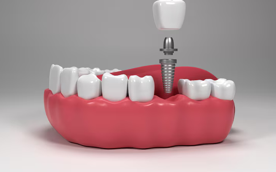 Single Tooth Implants in Asheville, NC: A Natural-Looking Solution for Missing Teeth